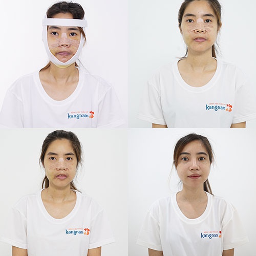 quá trình hồi phục nguyễn thị huê tại kangnam quá trình hồi phục nguyễn thị huê tại kangnam