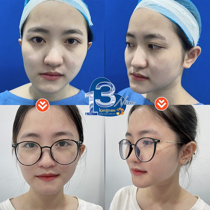 Khách hàng cằm lẹm, mất cân đối sau trượt cằm mặt đẹp thon gọn tự nhiên