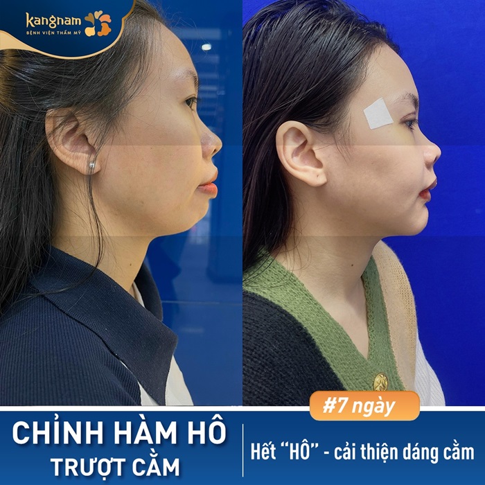 Khách hàng trượt cằm sở hữu khuôn mặt Vline hoàn hảo