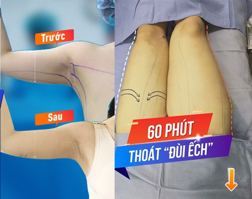 Cận cảnh kết quả giảm mỡ thành công bằng công nghệ cao không cần ăn kiêng của khách hàng mùa hè ăn gì giảm cân