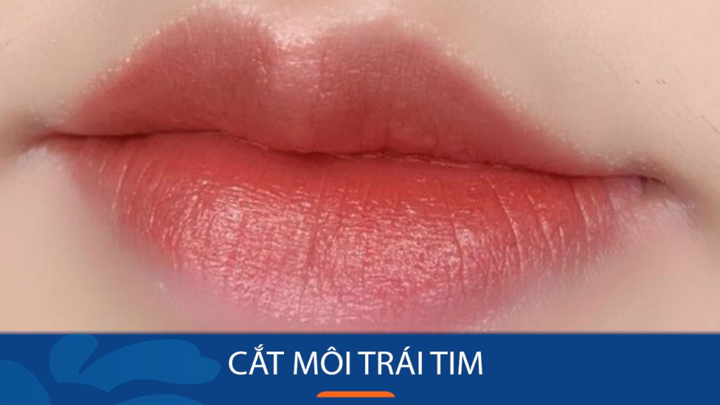 Cắt môi trái tim – Xu hướng thẩm mỹ môi mới nhất 2024