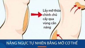 Nâng ngực bằng mỡ tự thân: Bí quyết sở hữu vòng 1 quyến rũ