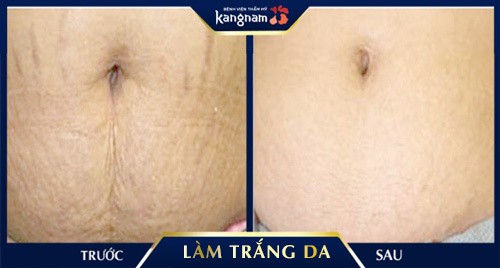 cách làm trắng da body sau sinh Kết quả thực tế sau 2 lần tắm trắng da toàn thân sau sinh