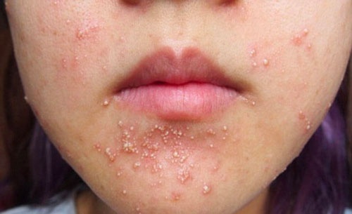 Biểu hiện thường gặp ở mụn nhân trắng
