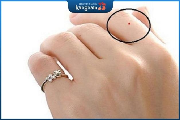 Nốt ruồi đỏ ngón tay trỏ là tốt