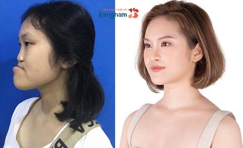 Thí sinh hở hàm ếch, mặt lõm Nguyễn Trang Nhung sở hữu khuôn mặt hài hòa, cân đối sau thẩm mỹ chương trình thay đổi cuộc sống phạm thị duyên