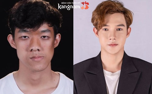 Dancer Minh Hoàng điển trai như nam thần Hàn Quốc, hết mặt lệch, mũi gãy chương trình thay đổi cuộc sống