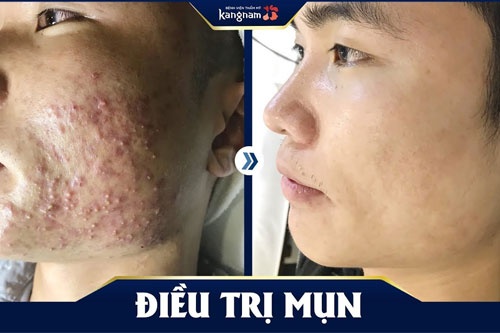 uống gì để trị mụn