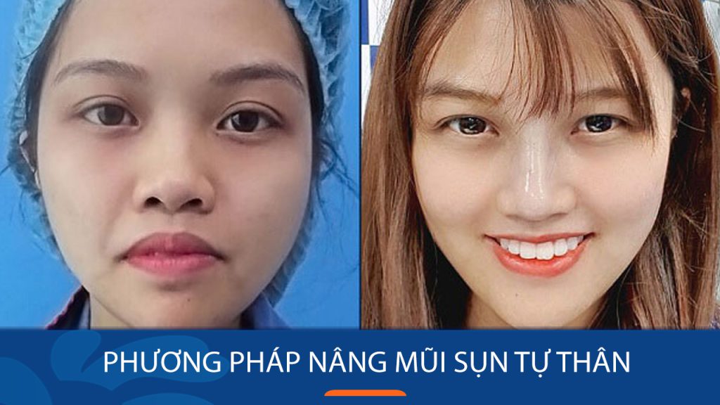 Nâng mũi sụn tự thân được bao lâu? Thời gian duy trì và yếu tố ảnh hưởng