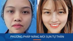 Nâng mũi sụn tự thân được bao lâu? Thời gian duy trì và yếu tố ảnh hưởng