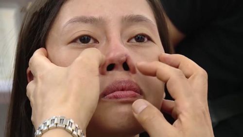 tháo sụn nâng mũi cấu trúc