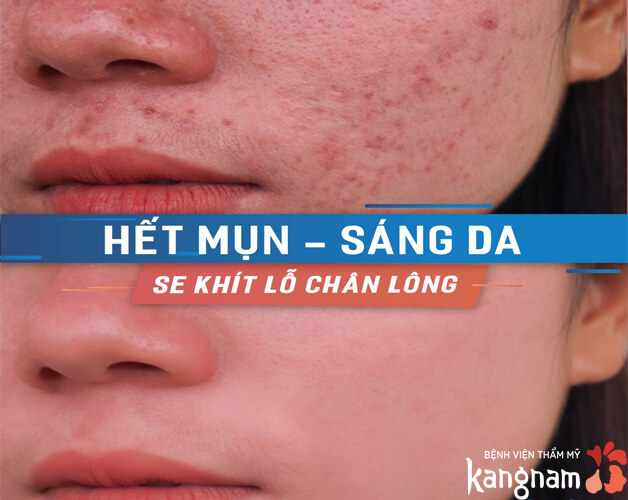 Công nghệ De Acne trị mụn siêu hiệu quả