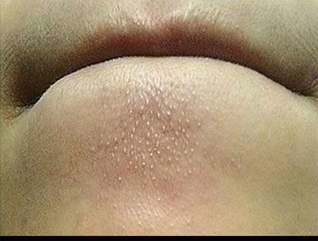 Nguyên nhân mụn ở cằm do gen di truyền