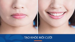 Tạo Khóe Môi Cười: Bí Quyết Đẹp Tự Nhiên Với Giá Hấp Dẫn