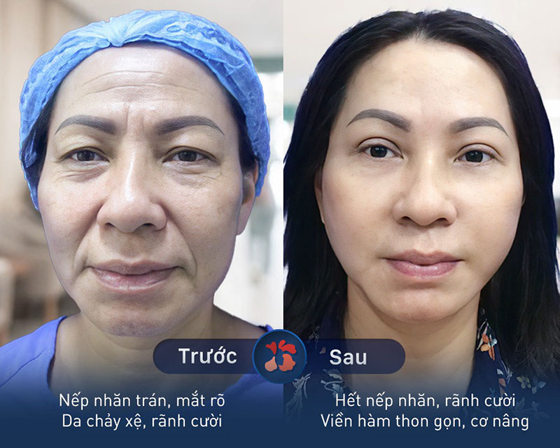 căng chỉ da mặt