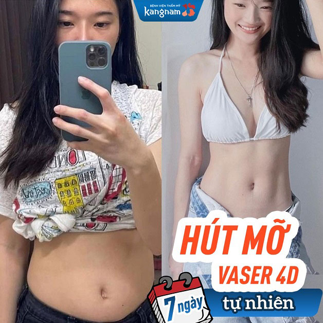 Khách hàng sau 7 ngày hút mỡ Vaser 4D thân trở nên thon gọn và nóng bỏng hơn