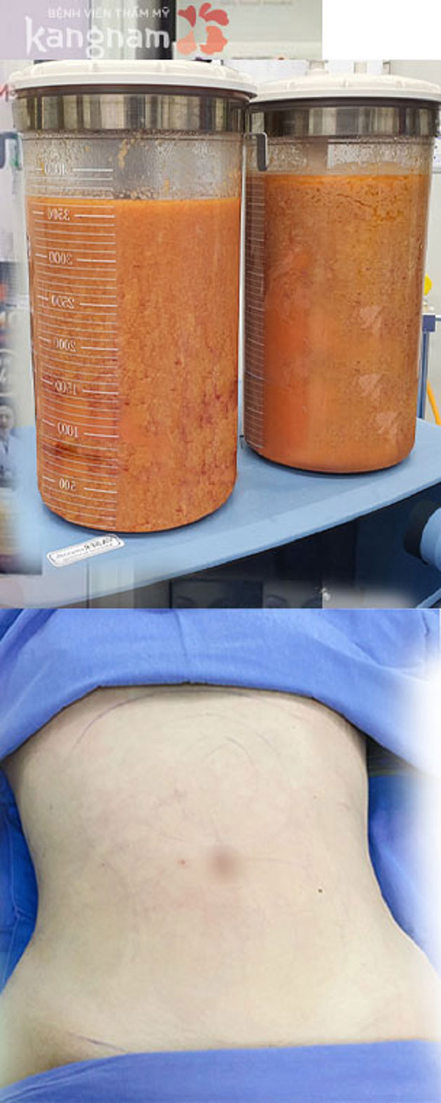 Mỡ bụng sau khi được đào thải ra ngoài 