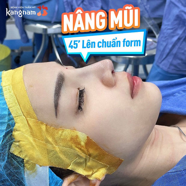 Nâng mũi cấu trúc