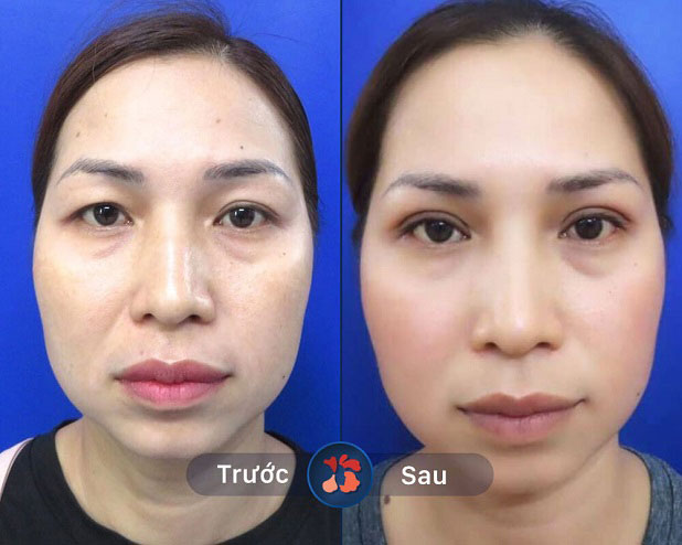 Khách hàng sau khi lấy mỡ mắt tại Kangnam