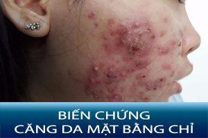 Căng da mặt bằng chỉ: Nguy cơ tiềm ẩn và cách phòng ngừa