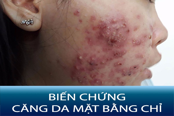 Căng da mặt bằng chỉ: Nguy cơ tiềm ẩn và cách phòng ngừa