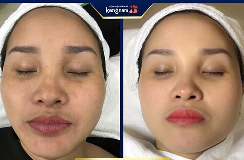 căng da hiệu quả căng da hiệu quả