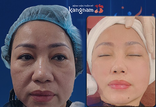 căng da thái dương là gì căng da thái dương là gì