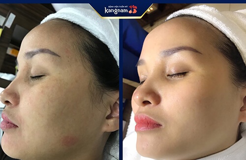 công nghệ căng da công nghệ căng da