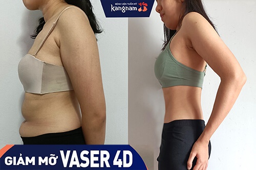 công nghệ hút mỡ vaser lipo 4d