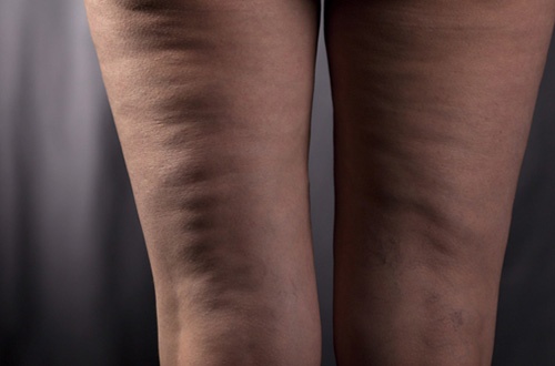 Khách hàng da đùi nhăn bẩm sinh