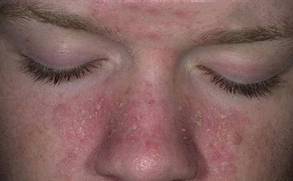 đầu mũi sưng to