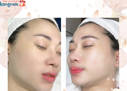 đối tượng căng da đối tượng căng da