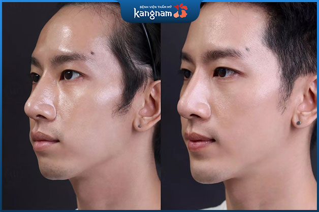 Độn cằm có hết hô không?