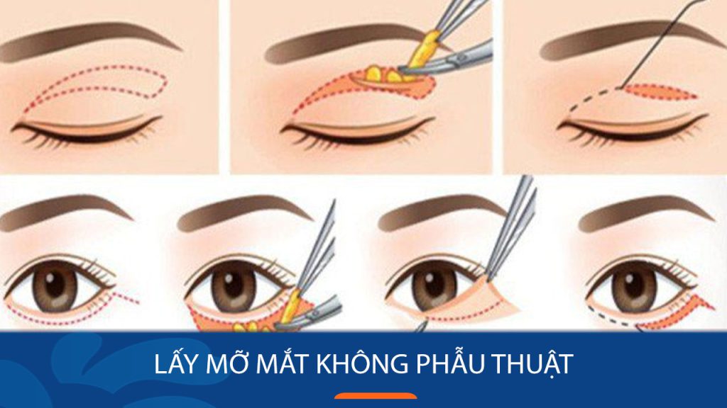 Lấy mỡ mắt không phẫu thuật là gì? Hiệu quả, rủi ro & ai nên thực hiện