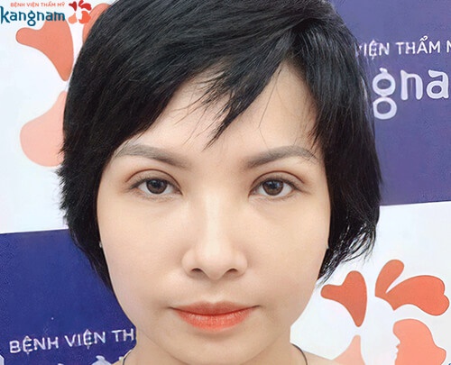 Lấy mỡ mắt không phẫu thuật là như thế nào