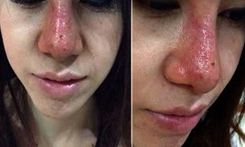 Mũi gặp tình trạng nhiễm trùng sau khi nâng mũi