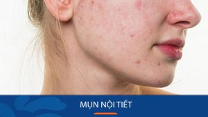 Bí quyết đánh bay mụn nội tiết dứt điểm trong 7 ngày chỉ với 1 bí kíp đơn giản!