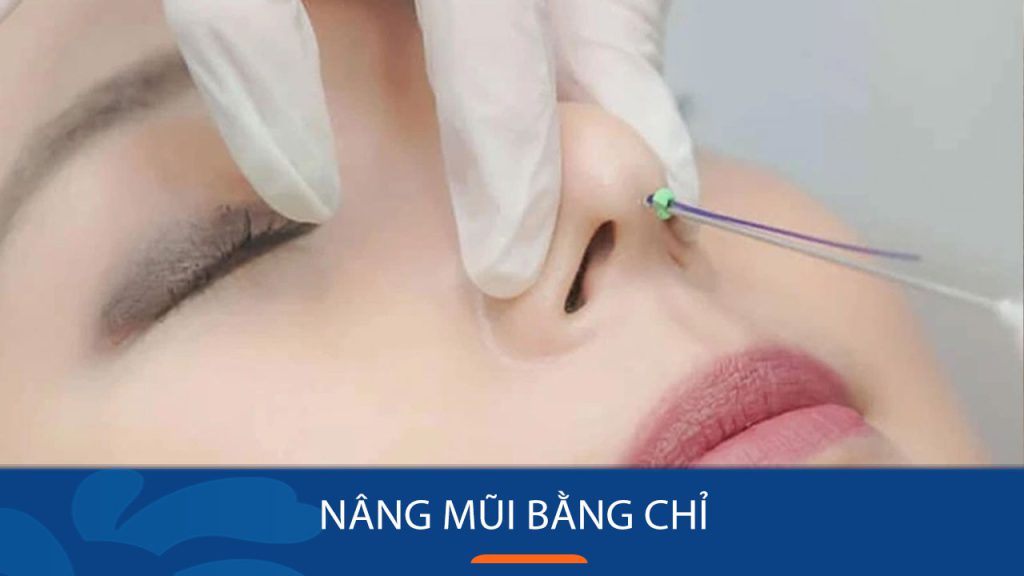 Nâng mũi bằng chỉ là gì? Hiệu quả, rủi ro và những điều cần biết