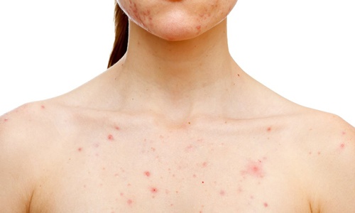 nhận biết mụn nội tiết