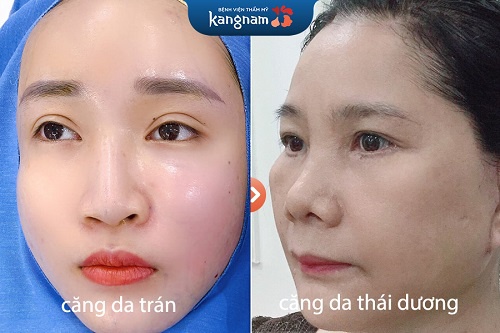 so sánh dịch vụ căng da so sánh dịch vụ căng da