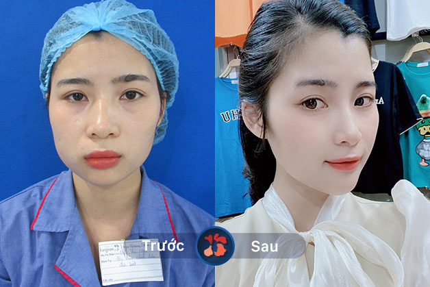 Khách hàng trước và sau khi độn cằm