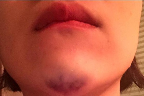 Cằm bị tổn thương