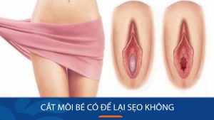 Cắt môi bé có để lại sẹo không? Cách trị sẹo và chăm sóc giúp ‘cô bé’ mịn màng