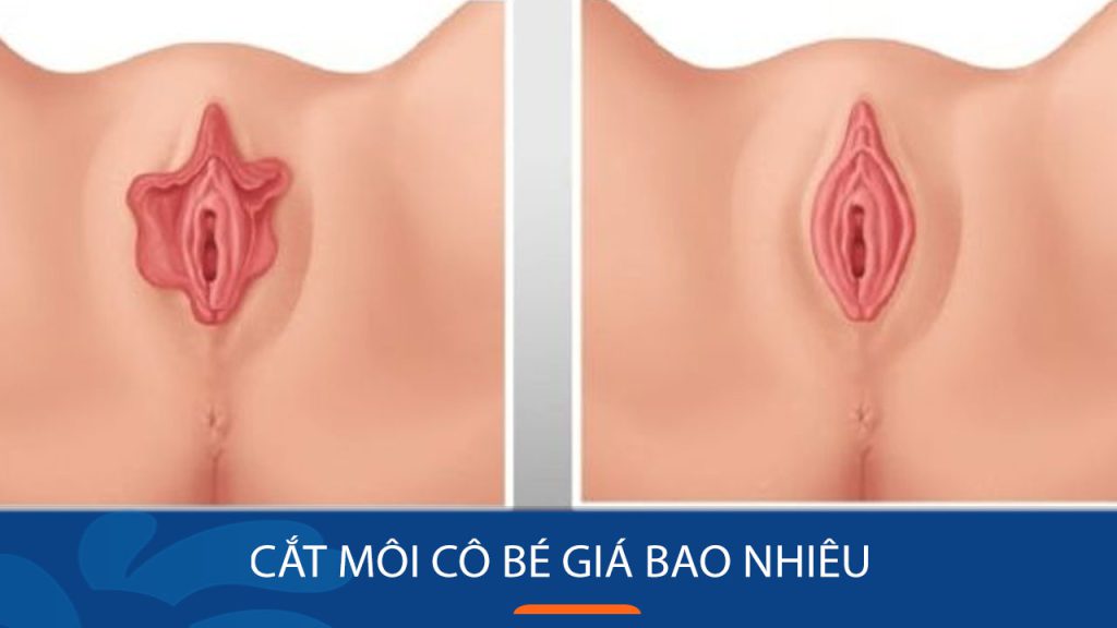 Cắt môi bé tại Kangnam giá bao nhiêu? Bảng giá mới và các yếu tố ảnh hưởng