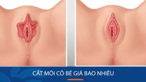 Cắt môi bé tại Kangnam giá bao nhiêu? Bảng giá mới và các yếu tố ảnh hưởng