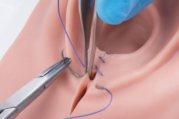 cắt môi cô bé để môi bé hoàn toàn lành lặn và ổn định, chị em tuyệt đối KHÔNG LÀM CHUYỆN VỢ CHỒNG nhé.