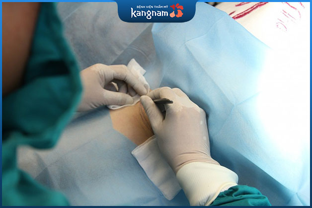 Tìm hiểu về phương pháp cắt tuyến mồ hôi nách