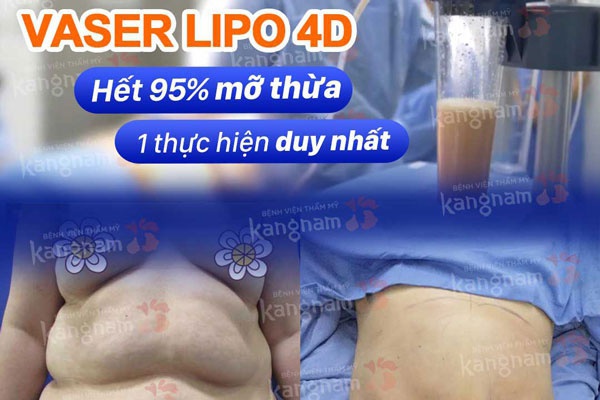 công nghệ hút mỡ vaser lipo 4d