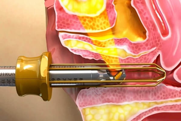 cắt môi bé có để lại sẹo không