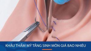 Bảng giá dịch vụ khâu thẩm mỹ tầng sinh môn cập nhật mới nhất